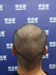 -碧莲盛·不剃发植发