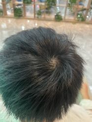 -碧莲盛·不剃发植发