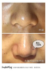 脸部抗衰-光SPA科技美肤