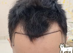 -大麦微针植发全国连锁