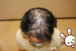 -大麦微针植发丨全国连锁