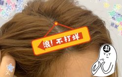 -大麦微针植发全国连锁