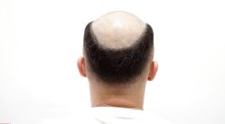 -发饰美男士增发补发假发定制店