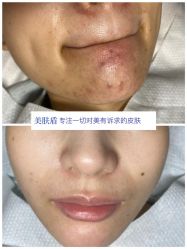 -美肤盾祛痘·问题肌头疗管理中心
