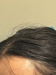 -碧莲盛·不剃发植发