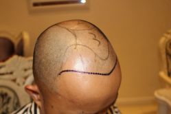 -大麦微针植发丨全国连锁