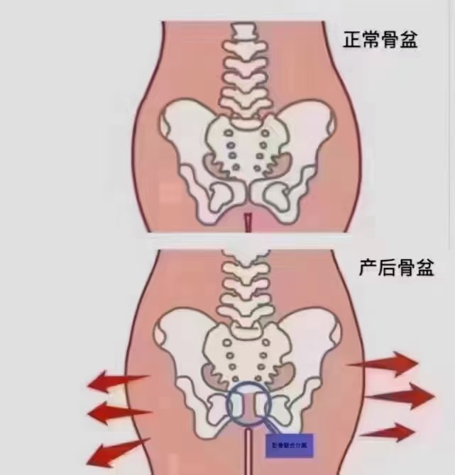 盆骨闭合图解图片