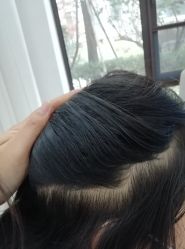 -大麦微针植发丨全国连锁