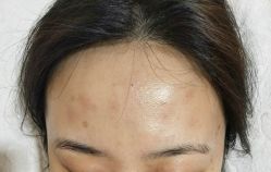 -北京美痣堂古方祛痣斑疣瘊
