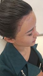 -大麦微针植发丨全国连锁