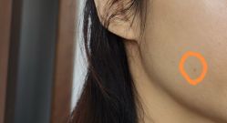 体验后-针美汇欧邦医疗美容