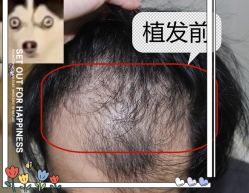 -大麦微针植发全国连锁