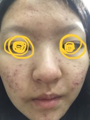 -苗方清颜专业祛痘连锁机构