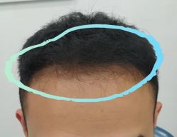 点击看大图 -大麦微针植发全国连锁