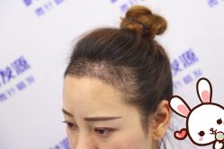 -大麦微针植发丨全国连锁