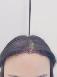 点击看大图 -大麦微针植发丨全国连锁