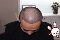 -大麦微针植发丨全国连锁