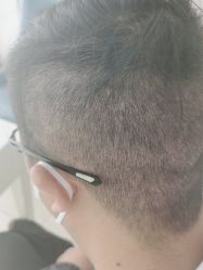 -大麦微针植发丨全国连锁