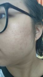 体验前-深圳米兰柏羽医疗美容医院