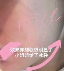 体验后-郡艺医疗美容·微整·眼鼻吸脂