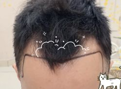 -大麦微针植发全国连锁