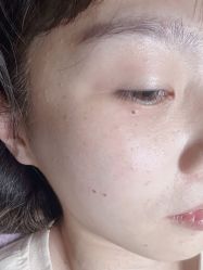 体验后-痣清宫祛斑祛痣连锁店