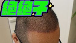 -大麦微针植发丨全国连锁