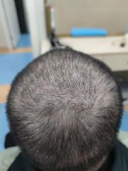 -碧莲盛·不剃发植发