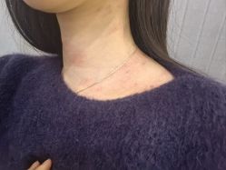 -爱莎扁平疣·汗管瘤·斑痣中心