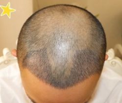 -大麦微针植发丨全国连锁