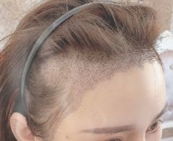 -大麦微针植发丨全国连锁