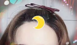 -大麦微针植发全国连锁