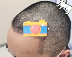 -大麦微针植发全国连锁