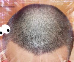 -大麦微针植发全国连锁