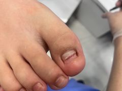 -Andrew指甲专科灰指甲·甲沟炎矫正·3D步态矫形鞋垫定制(浦三路店)