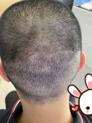 点击看大图 -大麦微针植发丨全国连锁