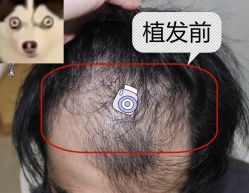 -大麦微针植发全国连锁