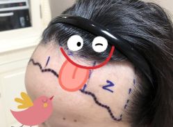 -大麦微针植发全国连锁