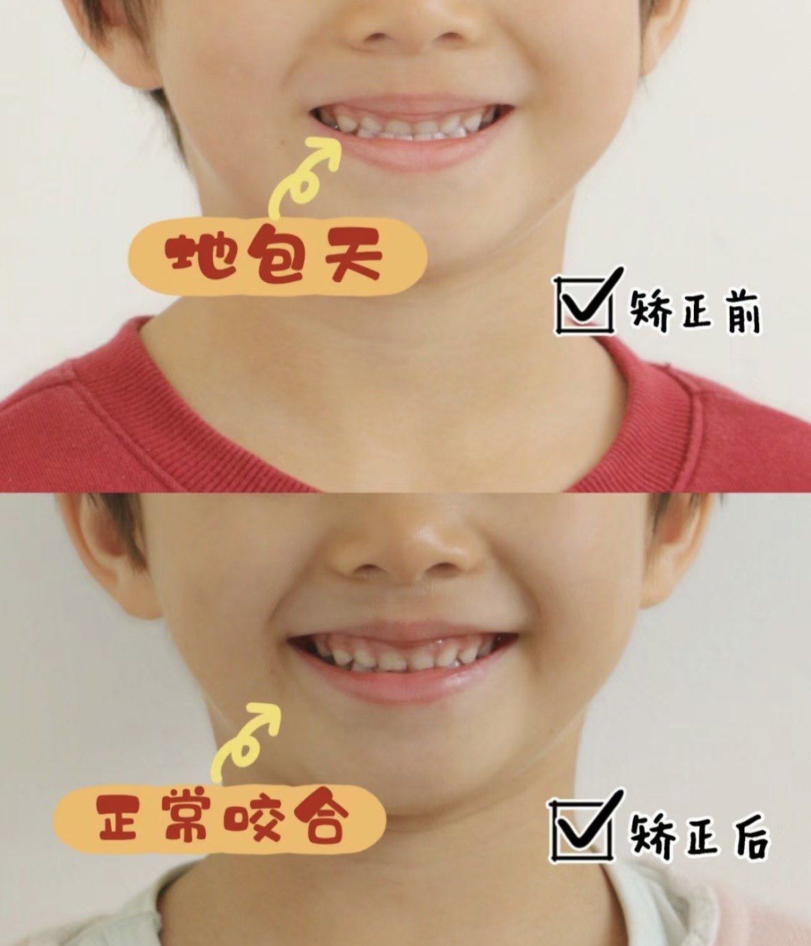 小朋友地包天怎么办?