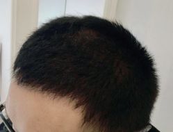 -大麦微针植发全国连锁