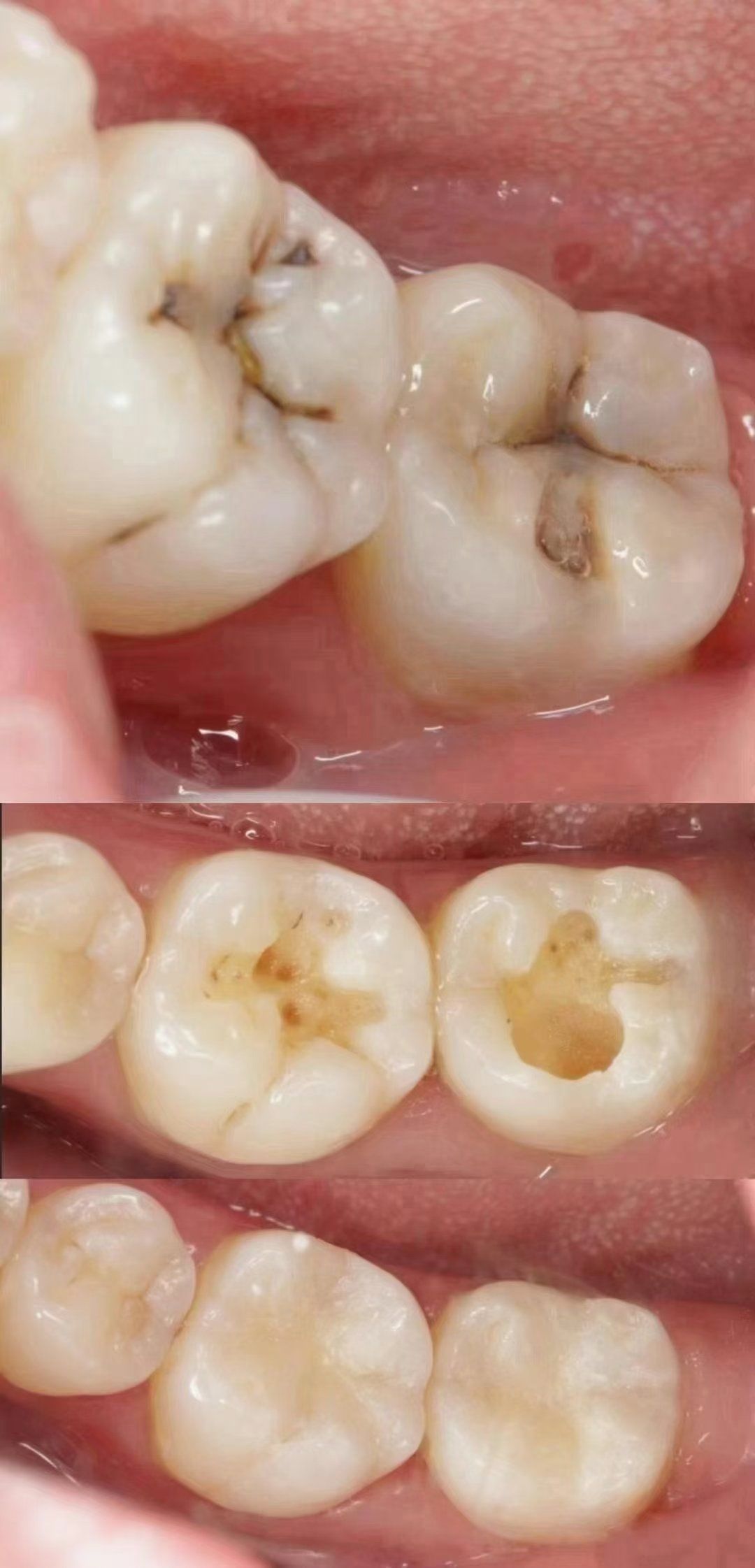 蛀牙 请止步于"浅龋",
别再等到