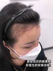 点击看大图 -大麦微针植发全国连锁