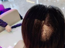 -碧莲盛·不剃发植发