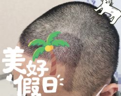 -大麦微针植发全国连锁