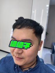 -大麦微针植发全国连锁