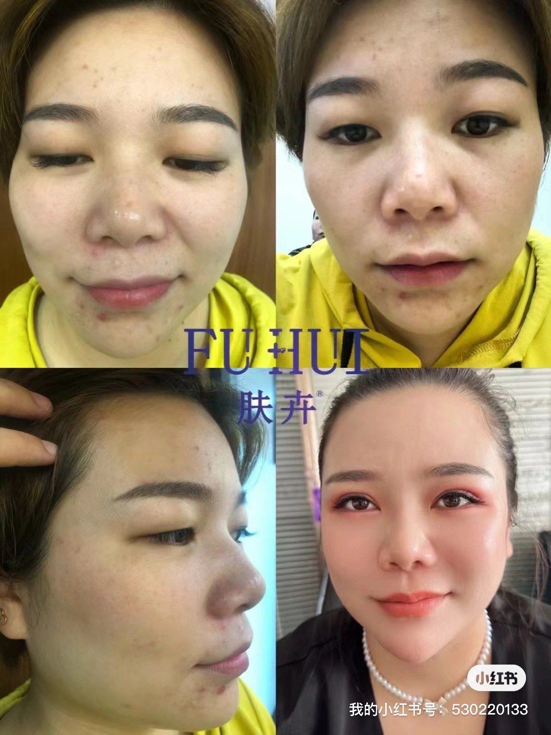 n让我们一同见证肌肤的完美蜕变#肌肤 #袪斑 #同城美容护肤