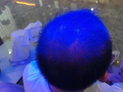 -碧莲盛·不剃发植发