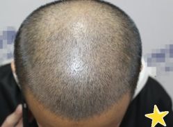 -大麦微针植发丨全国连锁