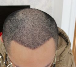 -大麦微针植发丨全国连锁