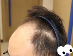 -大麦微针植发全国连锁